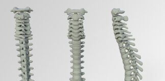 Czy wysokie ciśnienie może być od kręgosłupa? Czy wysokie ciśnienie może być od kręgosłupa?